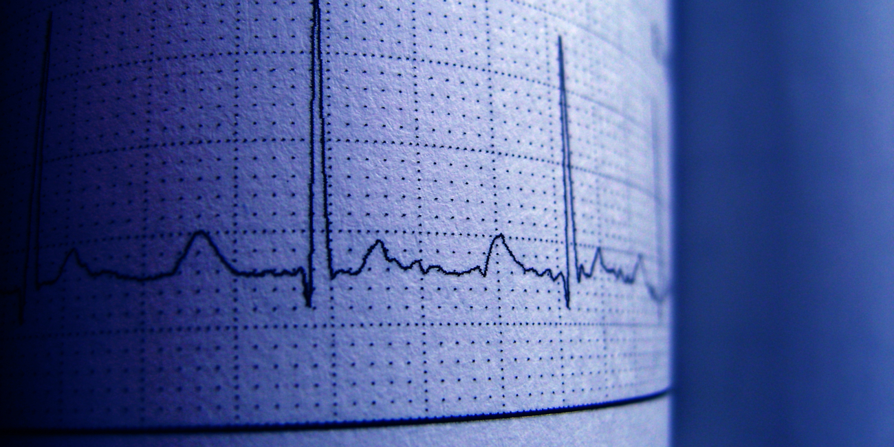 Tracciato ECG su carta