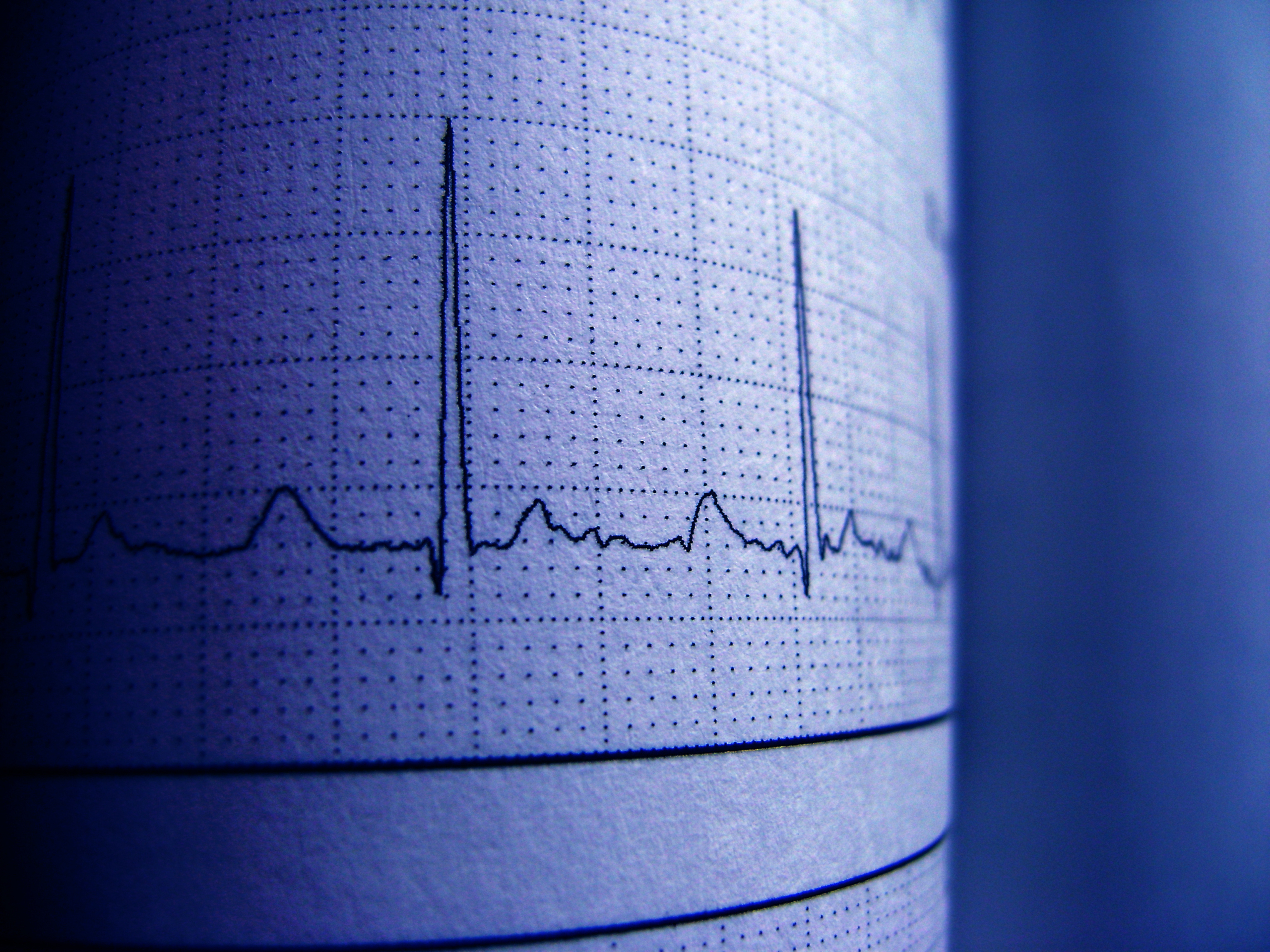 Tracciato ECG su carta