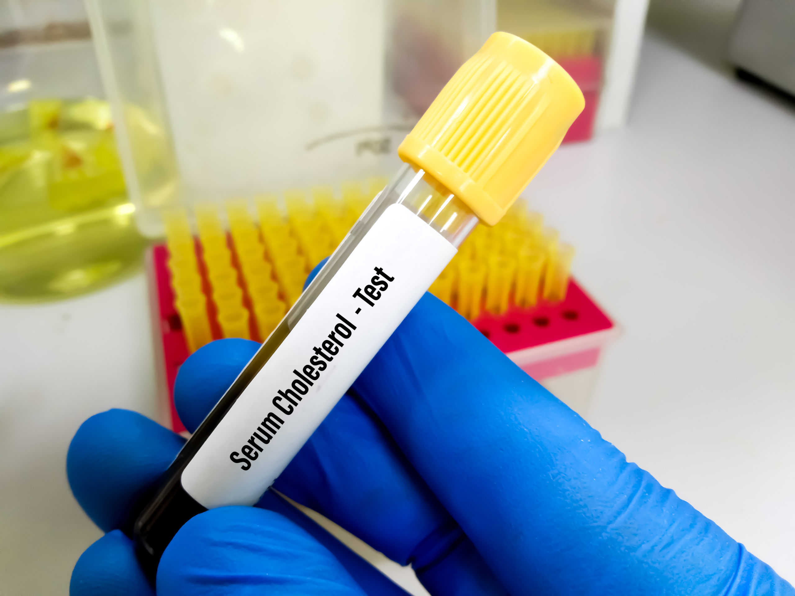 Analisi colesterolo sangue