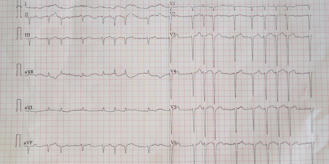 Fibrillazione atriale