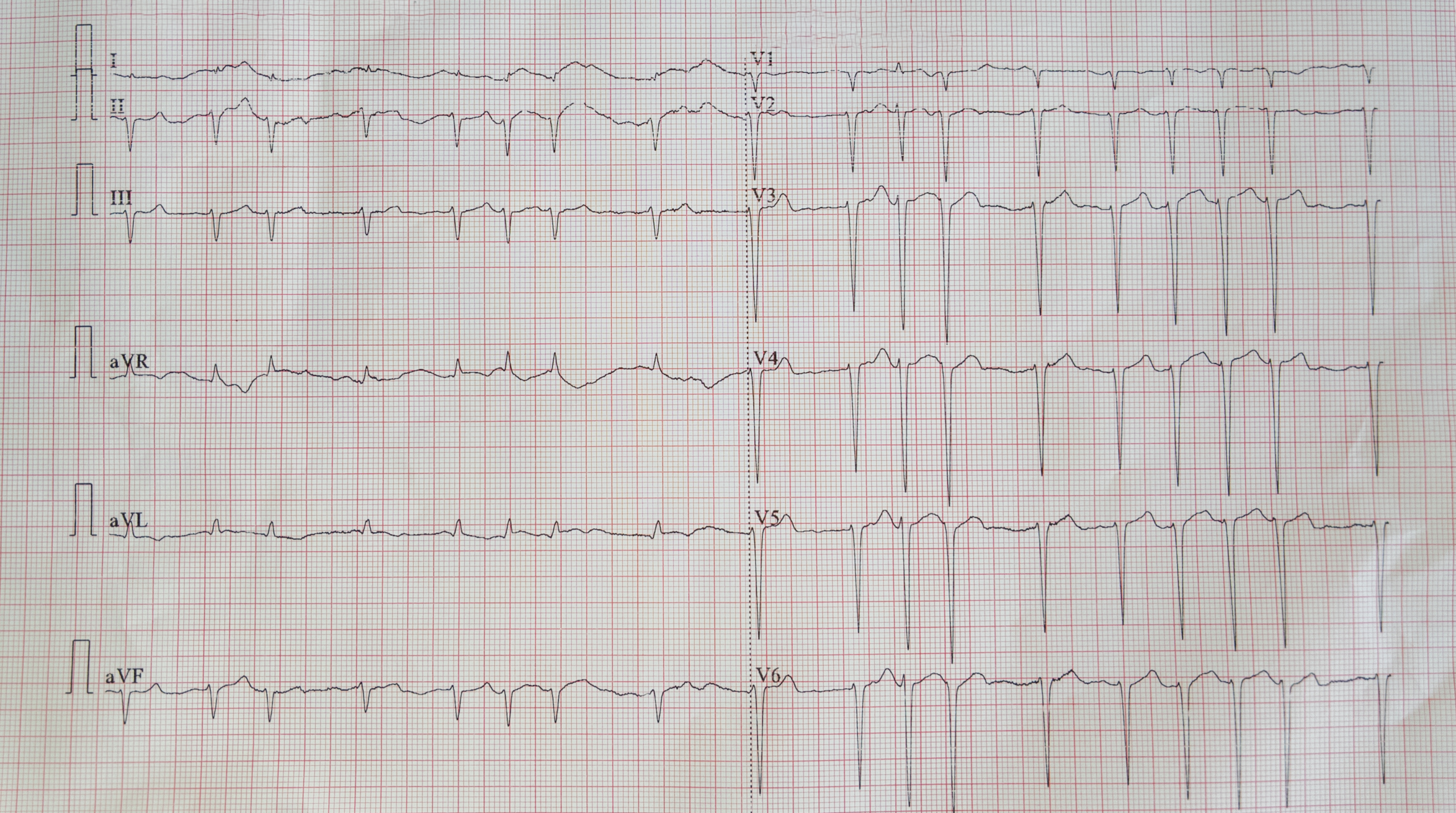 Fibrillazione atriale